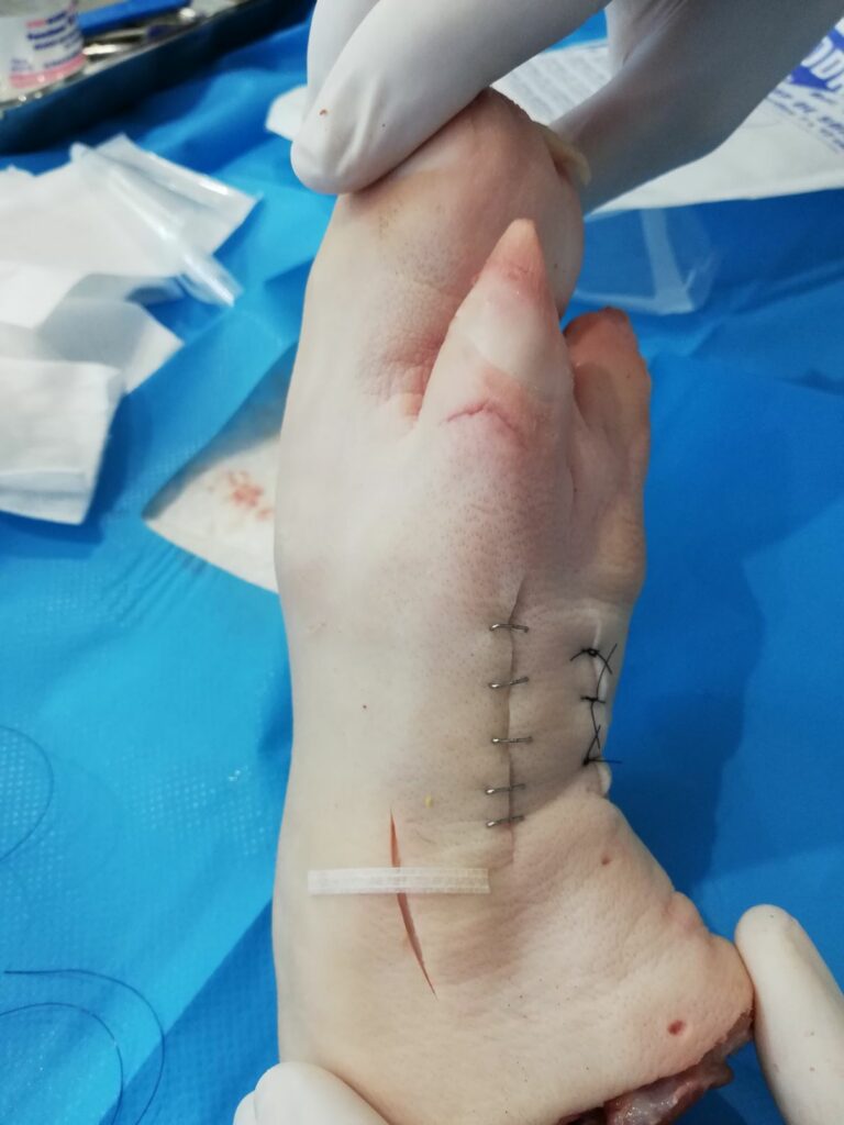 Suture sur pied de cochon